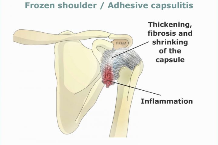 What is a Frozen Shoulder? Chiropractors in Southampton at The Avenue Clinic Explain